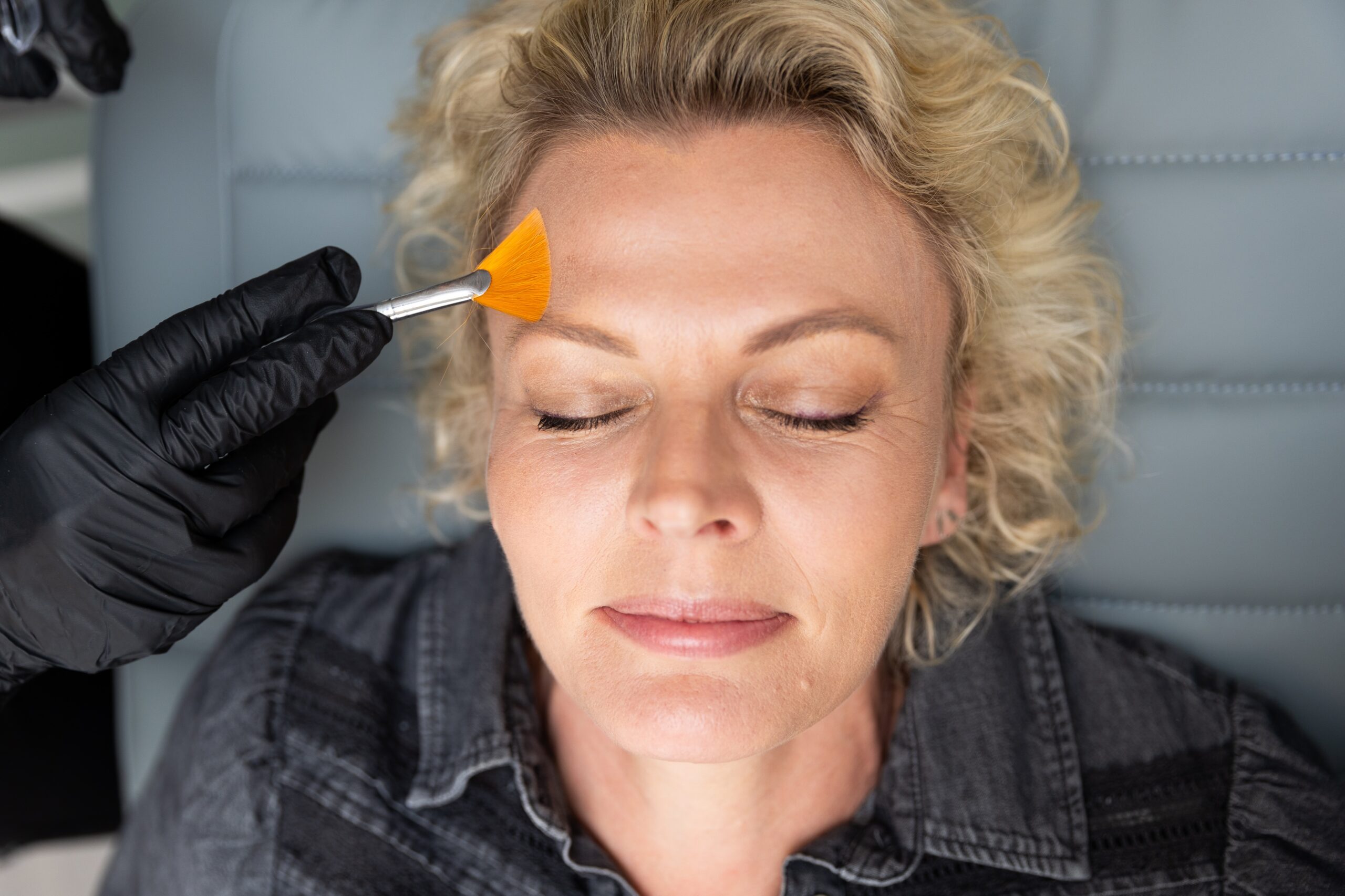 Chemical Peel and Resurfacers